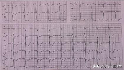 冠心病腿肿利尿药有用吗,冠心病腿肿就是心衰吗