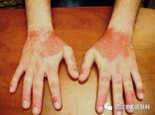 切断传播途径保护易感人群,切断传染源和保护易感人群