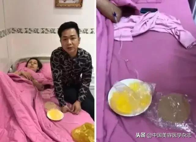 女歌手花1.4万元隆的胸在飞机上“爆了”！