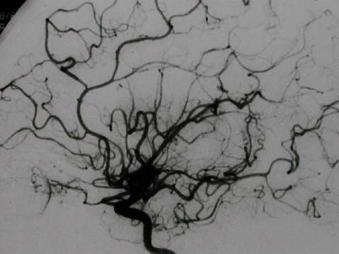 小孩有烟雾病会经常发烧吗,孩子烟雾病的症状