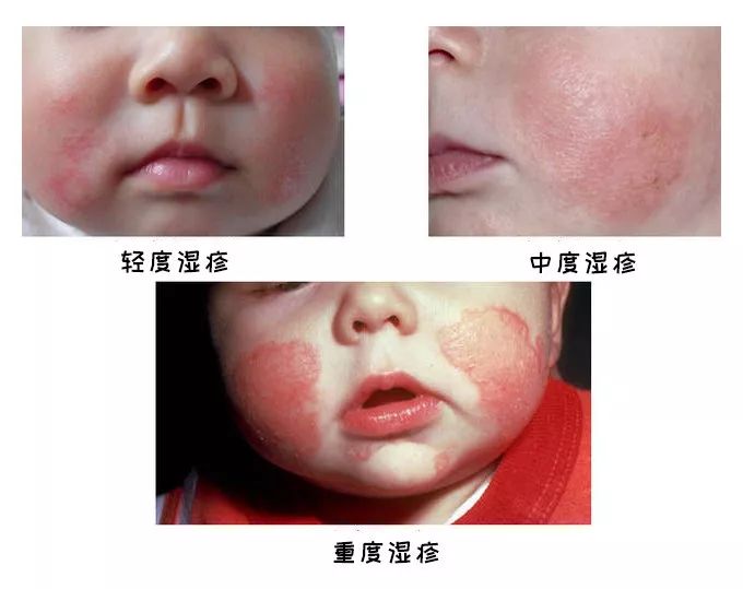 孩子湿疹老不好,孩子长期湿疹的最佳治疗方法