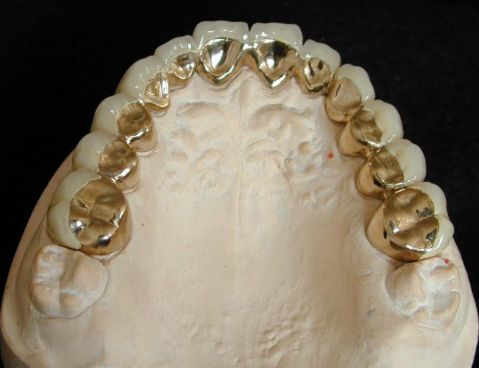 现在最便宜的假牙多少钱一颗,目前国内最好的假牙是多少钱