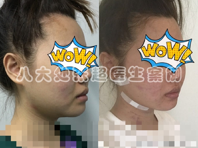 八大处整形张超,八大处张超最新视频