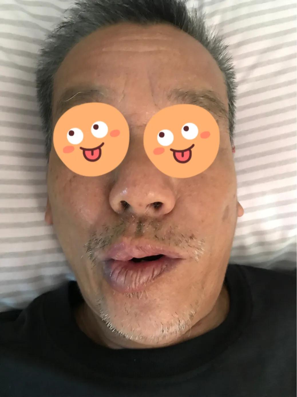 典型先兆性偏头痛怎么治,偏头痛左侧痛