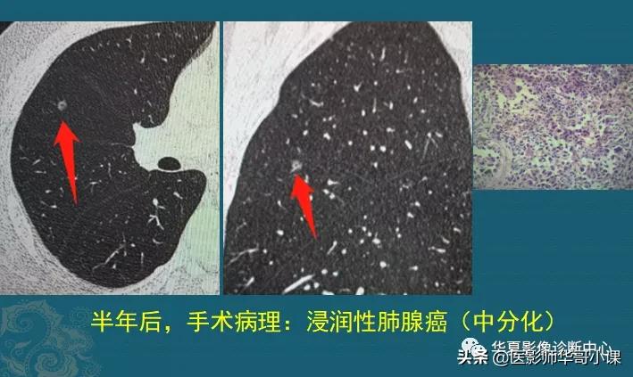 小细胞肺癌早期ct表现为什么结节,肺部ct显示有三处2cm结节是肺癌么