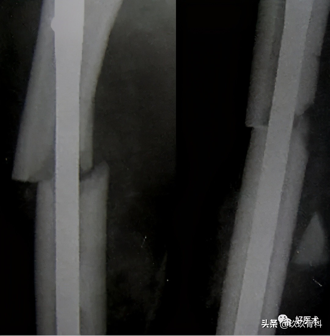 髓内钉技巧,髓内钉教学视频讲解