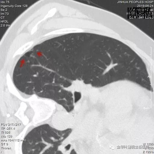 警惕-会是简单的肺大泡吗？