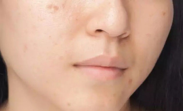 痘印表面好了里面没好,痘印发黑一直下不去用什么好
