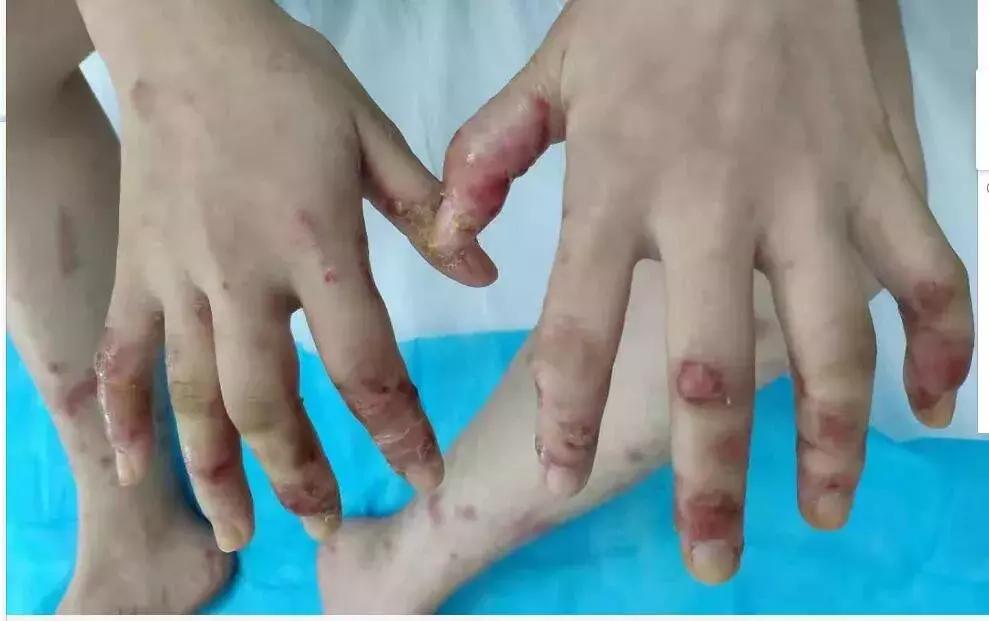 19岁女孩连续吃鱼,女孩因吃鱼身体发生变异