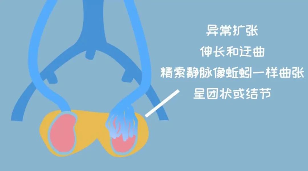 男性为什么会出现精索静脉曲张,男士精索静脉曲张会影响肾功能吗