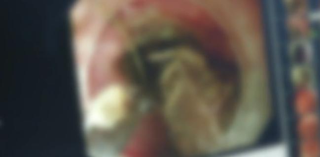 小孩误吞杏核怎么办,孩子误吞带壳杏核