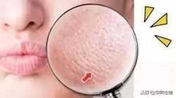 毛孔堵塞用水杨酸果酸泥膜好吗,果酸水杨酸护肤品推荐收缩毛孔