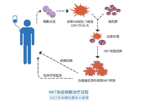 nkt癌症,中国有肿瘤nkt治疗吗