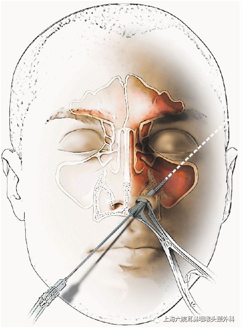 上颌窦炎穿刺手术全过程,上颌窦炎一般小门诊能治疗吗
