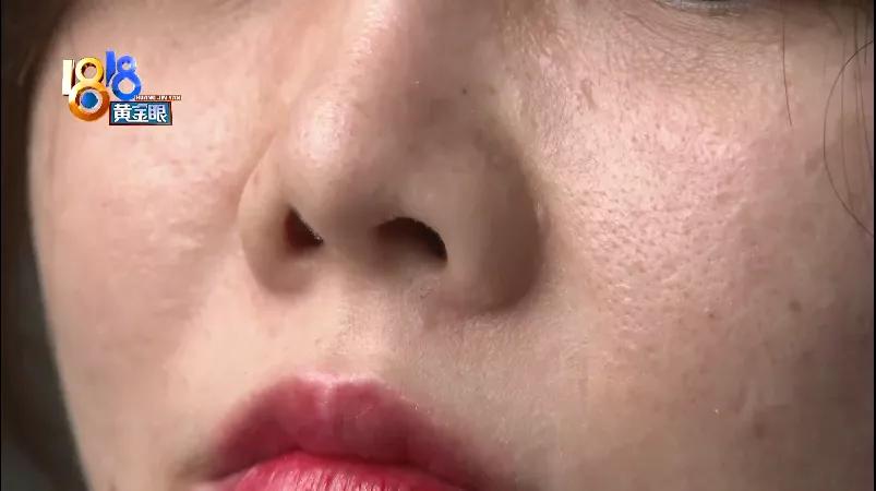 壹加壹做鼻子哪个医生好,壹加壹隆鼻图片