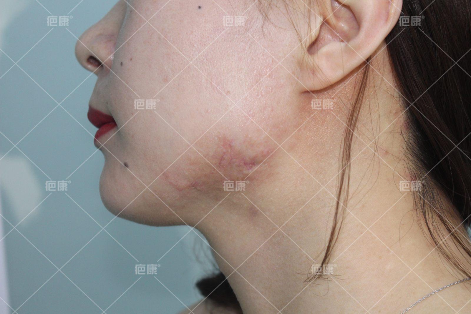 北京疤康对疤痕疙瘩能看好吗,疤康疤痕疙瘩恢复图片