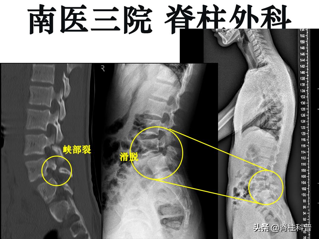 峡部裂导致的滑脱是不是必须手术,峡部裂保守治疗的方式有哪些
