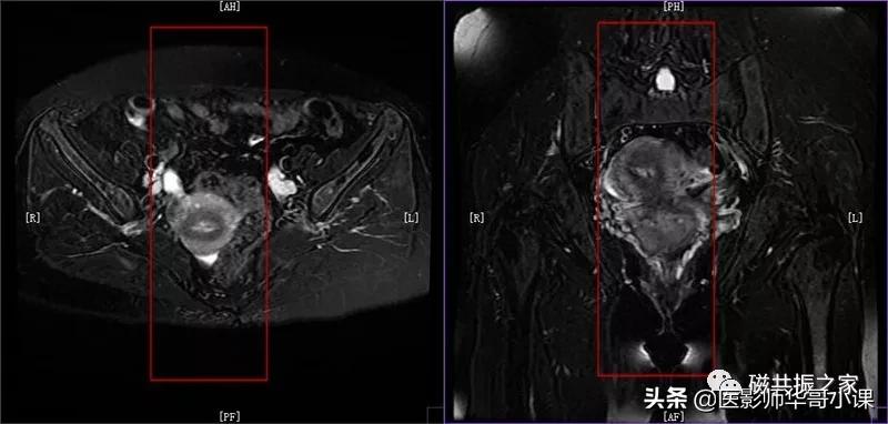 「精品课件」带大家看看,磁共振子宫MRI要如何扫描?