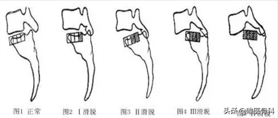 腰椎滑脱手术后卧床几天,一般腰椎滑脱手术需要卧床多久