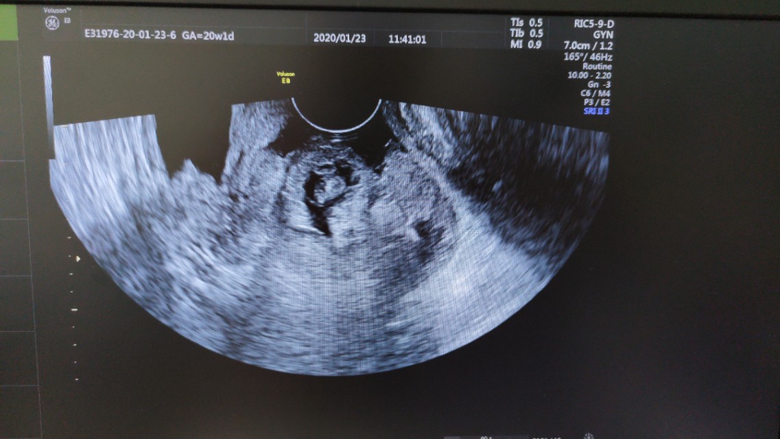 跑偏了的受精卵，竟化身为一颗夺命*弹炸**！