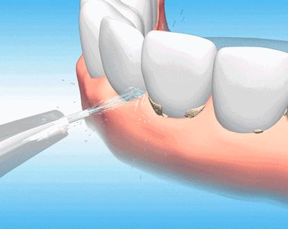 牙齿松了如何固齿,撞松牙齿松动了怎么样才能固齿