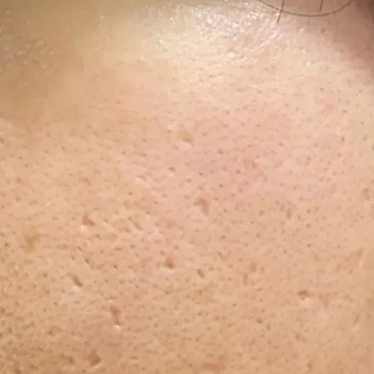 辟谣、吃酱油加深痘印?芦荟胶治好痘坑?别傻了!