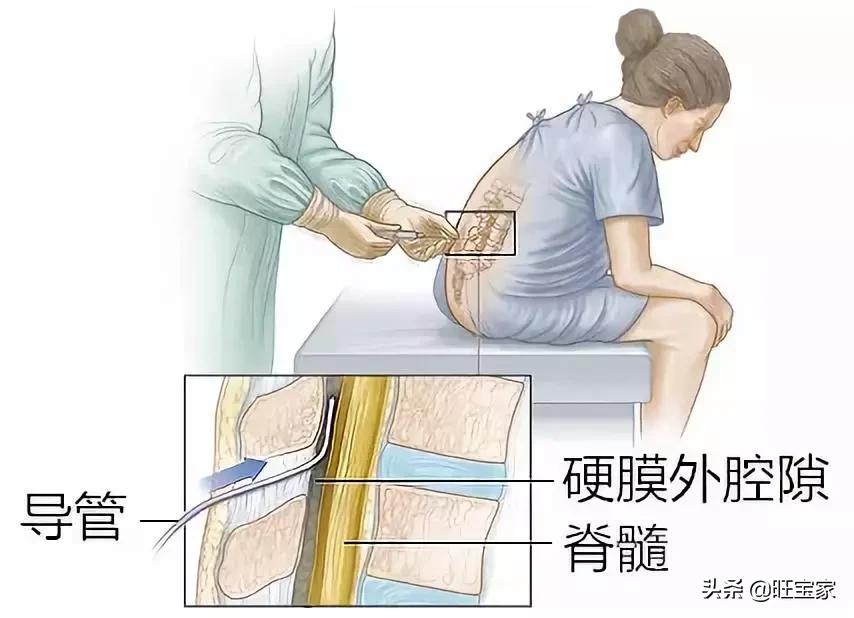 关于无痛分娩的所有困惑，看这一篇就够了！