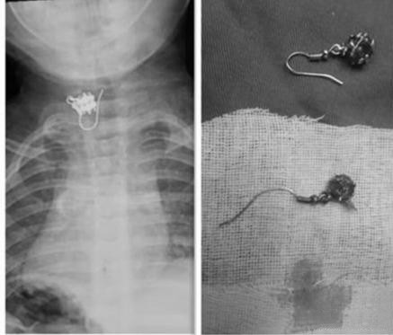 小孩不小心吞了耳环,小孩误吞耳环已经到胃里如何处理