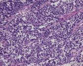 菁讲:你所不知道的横纹肌肉瘤