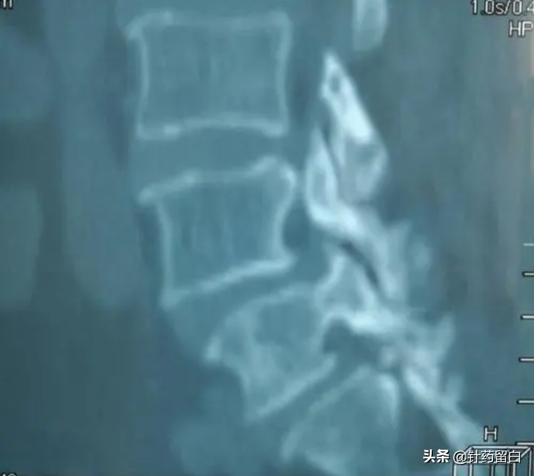 一文读懂靶向治疗,一文看懂椎体成形