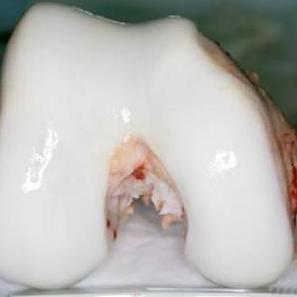 骨质增生和骨关节炎补钙有用吗,骨刺骨质增生关节炎用什么药