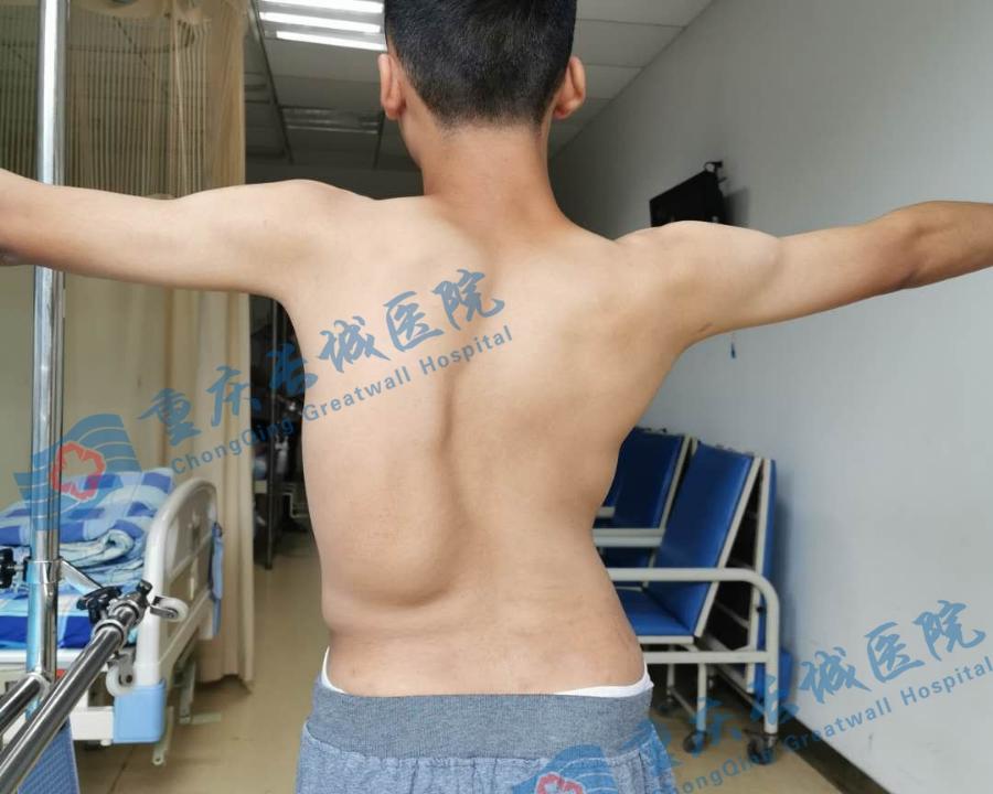 关爱脊柱健康儿童脊柱侧弯,关注脊柱侧弯让孩子少走弯路