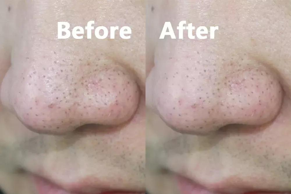 用芦荟胶去除粉刺,芦荟胶真的可以去黑头吗