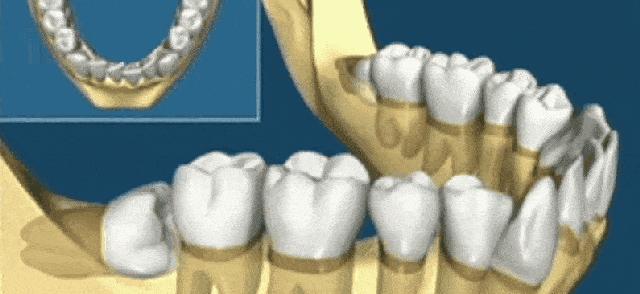 拔智齿断的一点在里面没有关系吗,拔智齿断了牙根留在里面如何处理