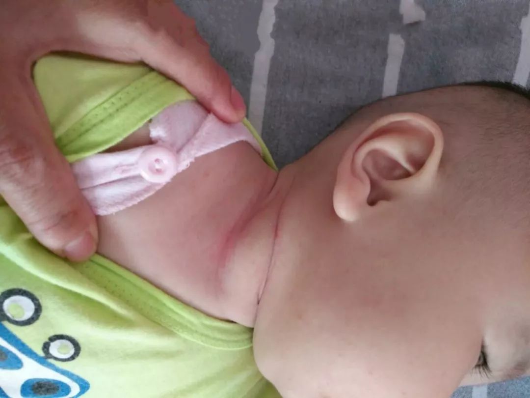 小儿肌性斜颈表现及治疗方案,婴儿肌性斜颈肿块多大算严重