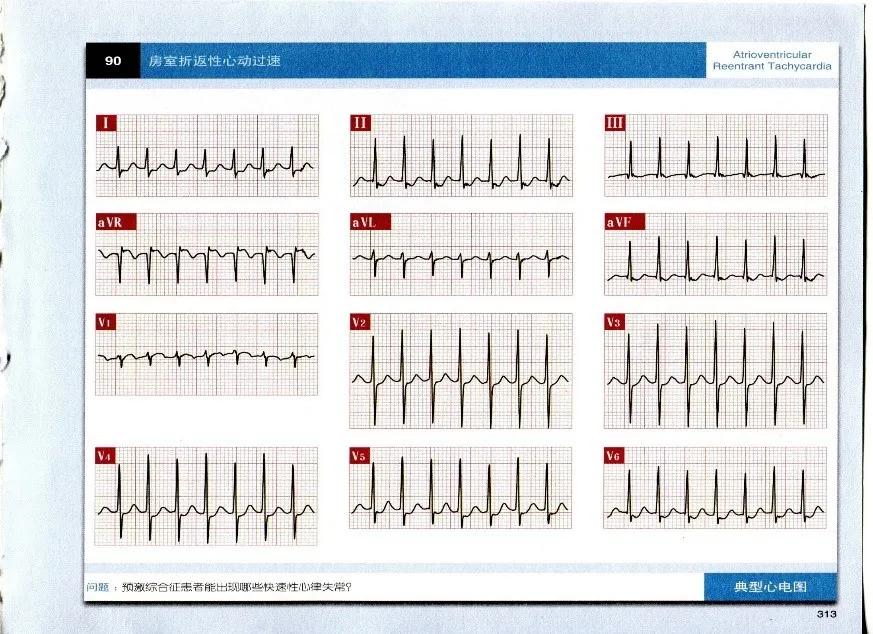 得了预激综合征严重吗,为什么会得预激综合征