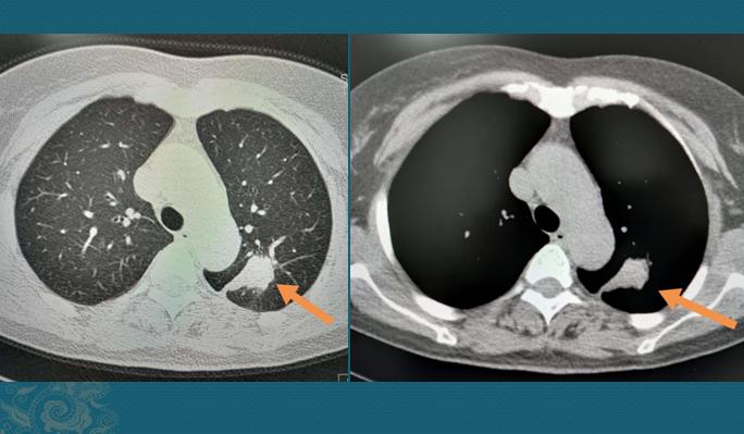 新冠肺部感染应对,新冠肺癌抗癌