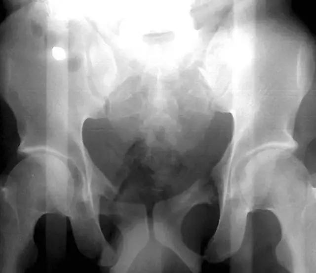 几种严重骨折医学名称,常见的骨折有哪些名称