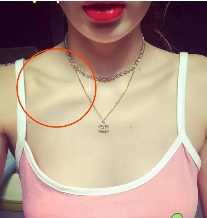 泫雅畸形锁骨,泫雅锁骨埋钉