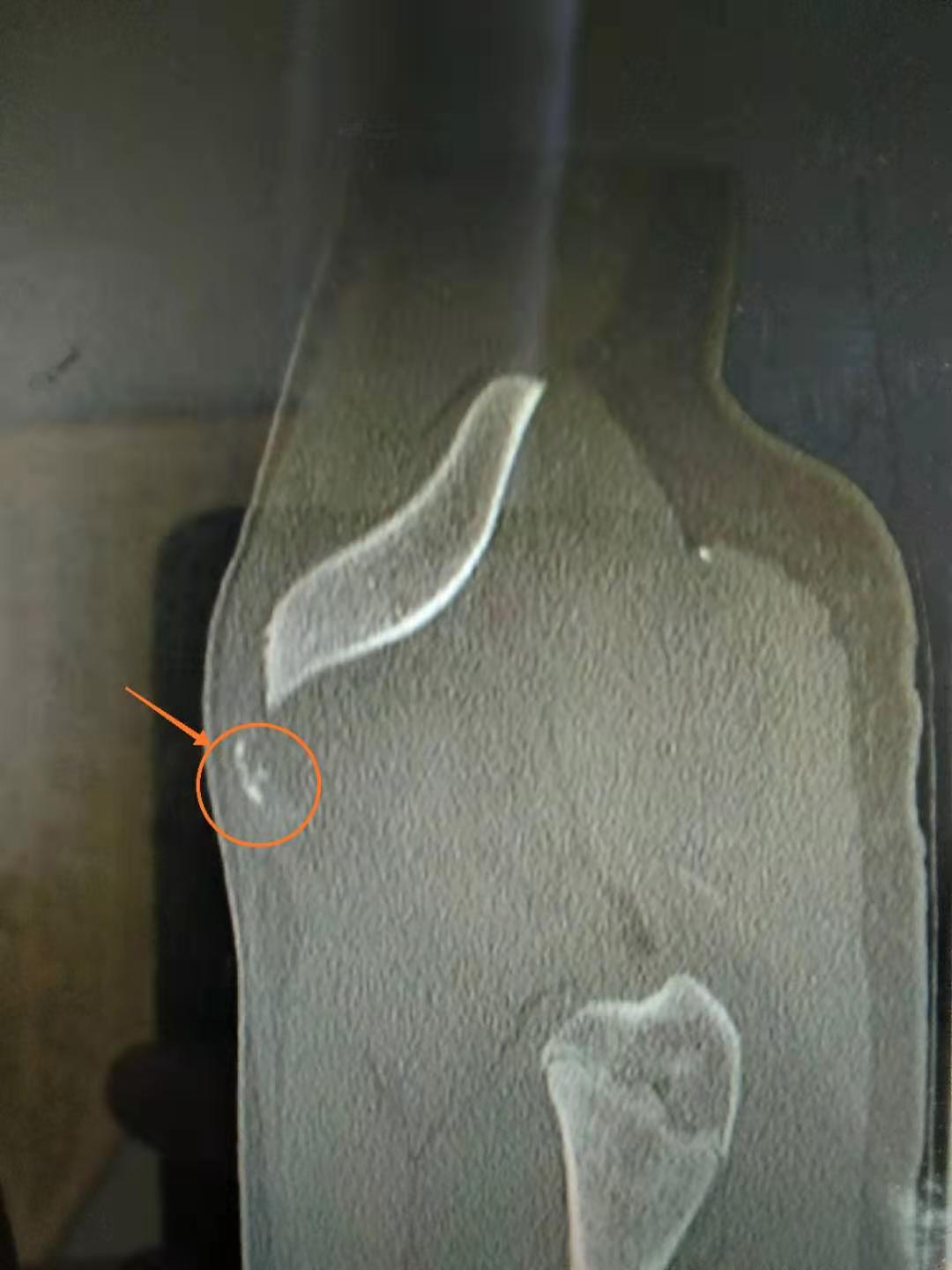 肌肉缺失容易骨折吗,肌肉累导致骨折