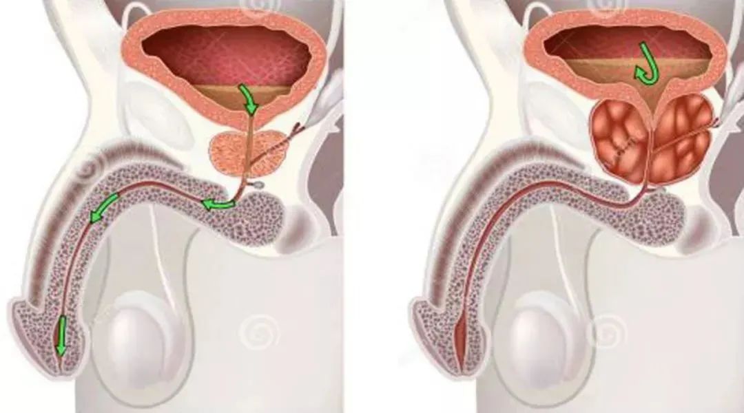「男性健康」低能量体外冲击波（ED1000）在“男性疾病”中的应用