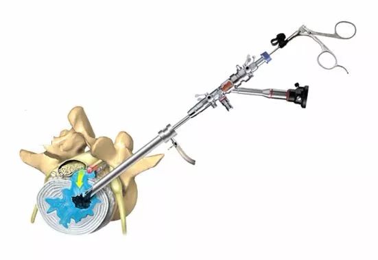 腰椎间盘突出并腰椎管狭窄怎么办,腰椎管狭窄腰椎间盘突出怎么治