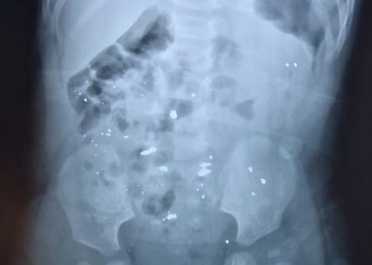 2岁男孩咬碎体温计后误吞水银,儿童咬破温度计误吞水银怎么办