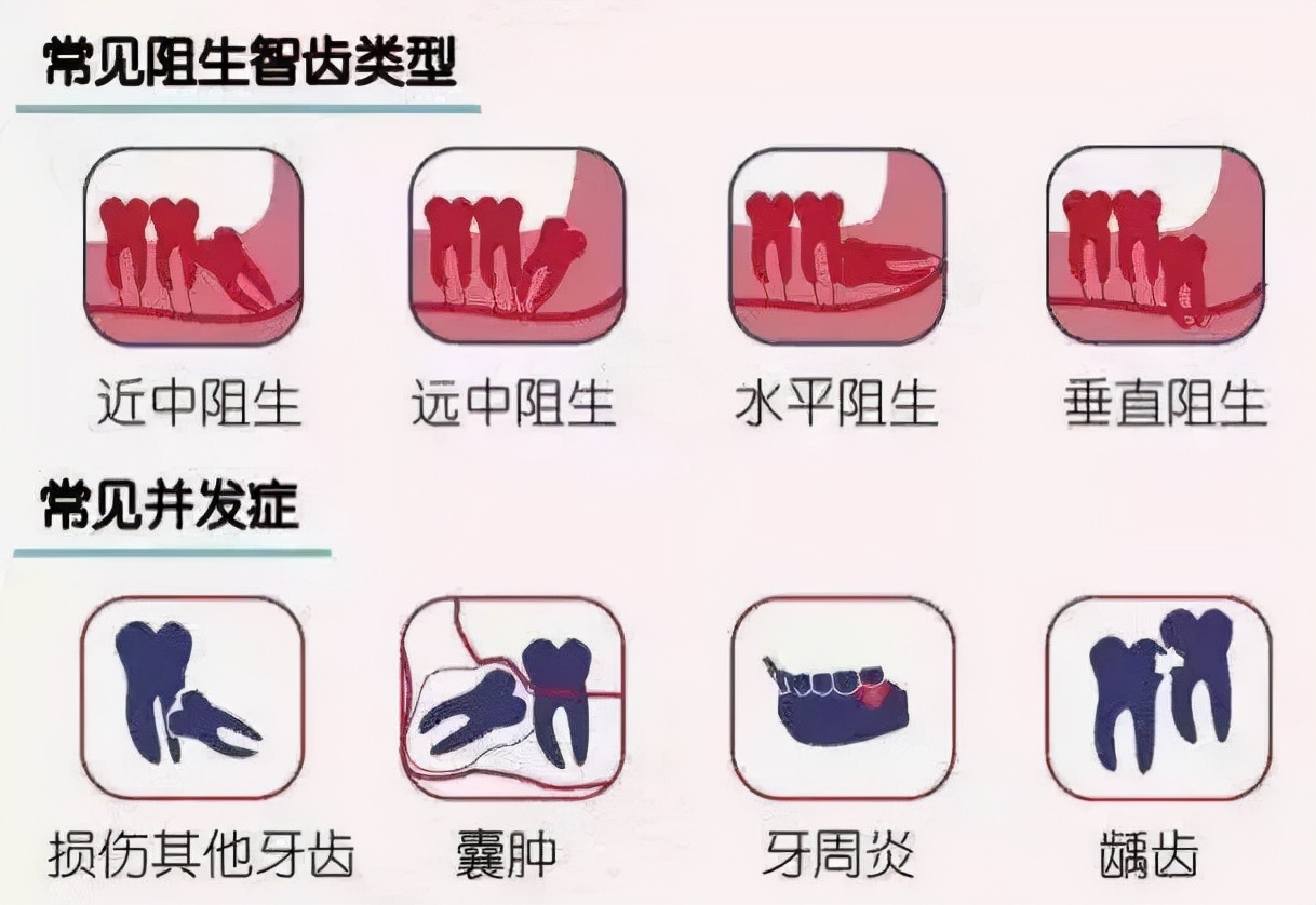 女子智齿烂脸,智齿发炎的真实案例