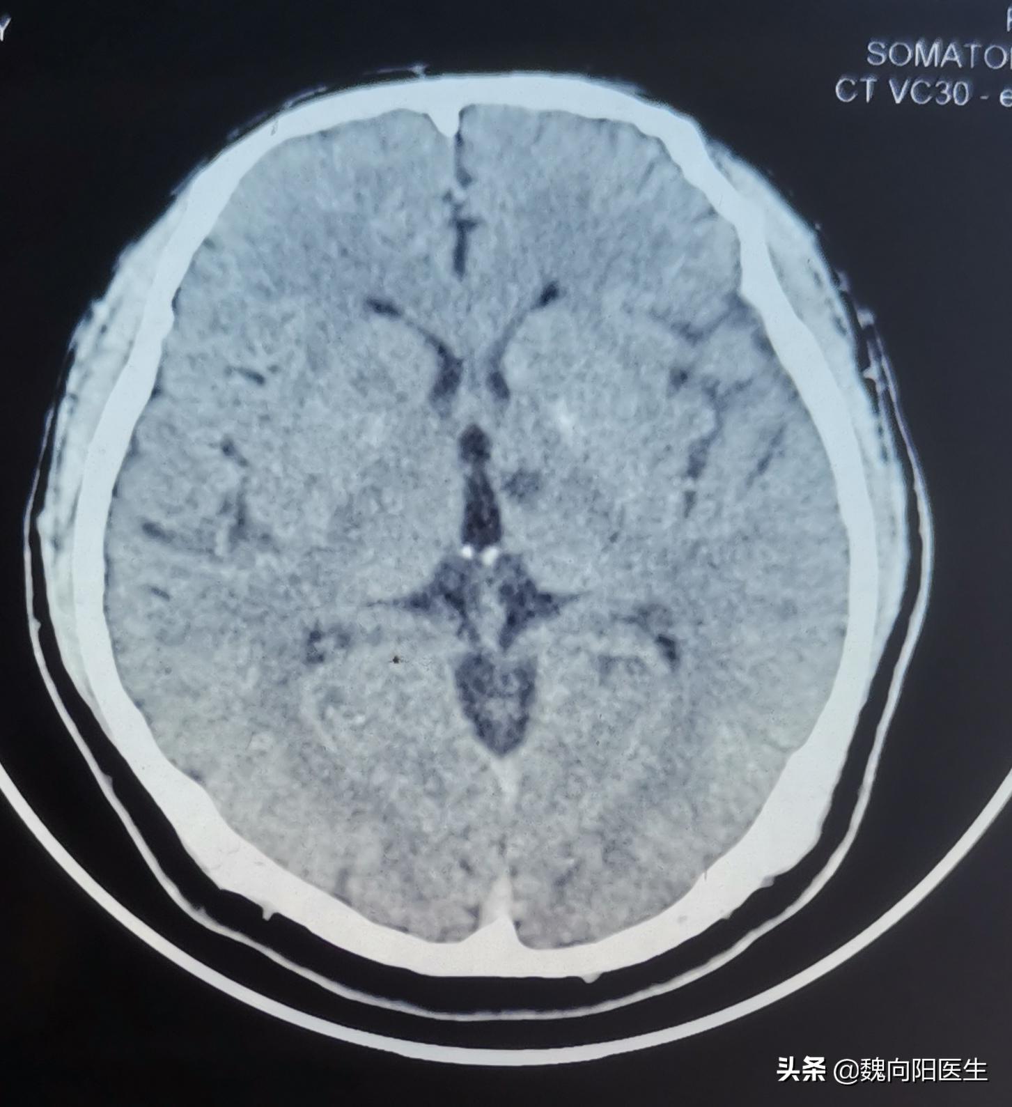 体检发现脑梗要住院吗,体检查出腔隙性脑梗塞需要治疗吗