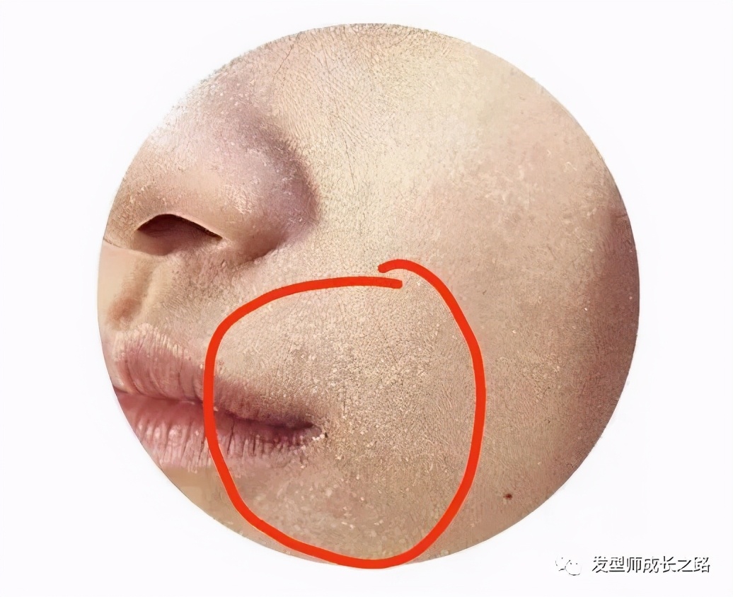 你真正了解ros吗,怎么真正治疗头皮屑