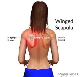 肩胛骨突出矫正的方法,体态矫正脊柱前凸