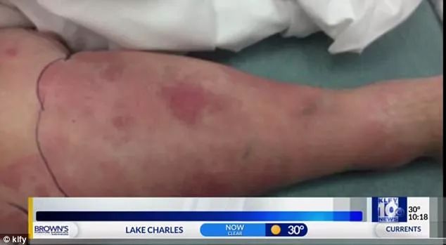 紧急！全澳多地出现“吃人菌”，感染后如同丧尸！24小时可吃一人