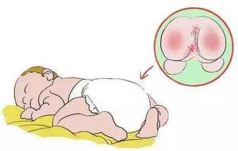 宝宝得了肛瘘怎么治愈,小宝宝肛瘘是什么症状