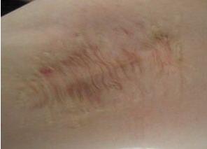 腋臭治疗篇,腋臭治疗合集